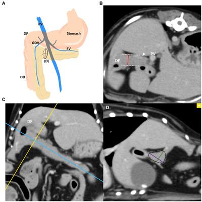 Computed tomographic measurements of pancreatic thickness in clinically normal dogs